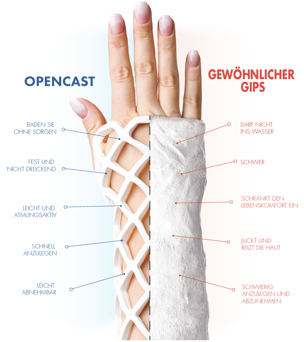 Běžná sádra vs OPEN CAST